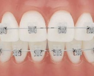 Brackets autoligantes Brackets autoligantes